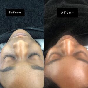 dermaplaning before and after results by beauty spa