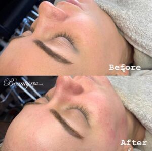 Chemical-peel-facial-treatment-beauty-spa-canterbury