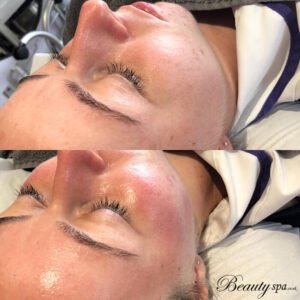 dermaplaning-facial-canterbury-beauty-spa-salon