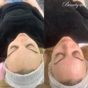 facial-treatment-dermaplaning-beauty-spa-salon