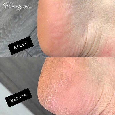 Callus peel pedicure in Canterbury by Beauty Spa