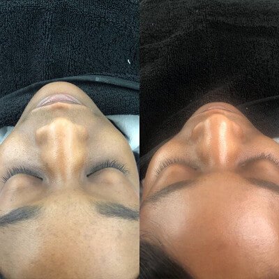 Dermaplaning in Canterbury by Beauty Spa