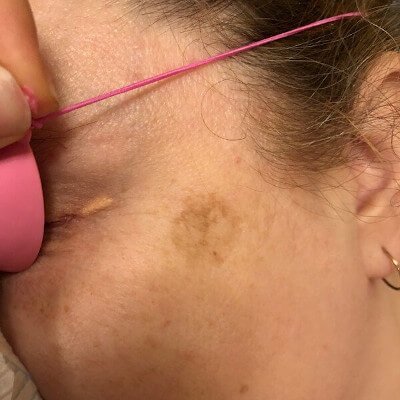 laser skincare by beauty spa in Canterbury