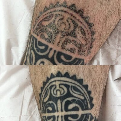 Canterbury Laser tattoo removal by beauty spa