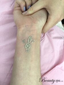 tattoo removal in canterbury by beauty spa